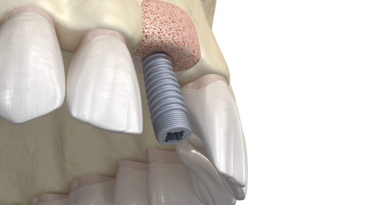 dental implant cost