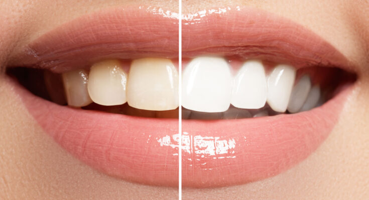 teeth whitening in dubai